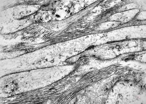 M,58y. | neurofibroma faciei M,58y. | neurofibroma faciei